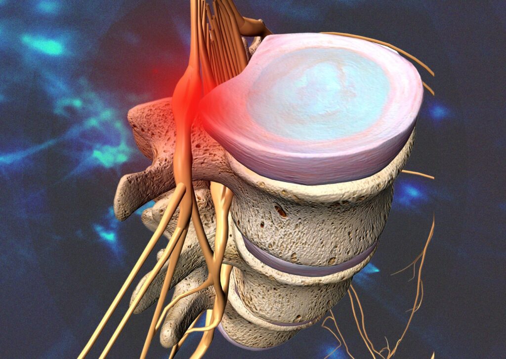 Sciatica caused by a herniated disk