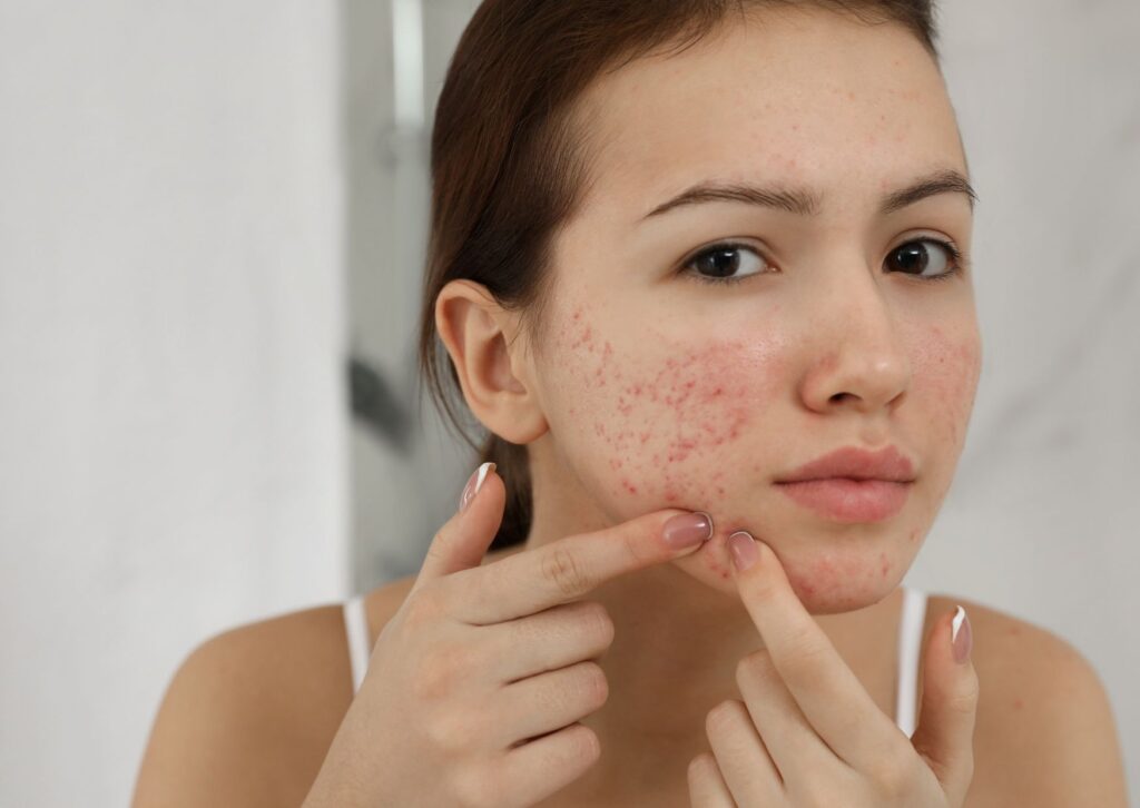 lady with acne